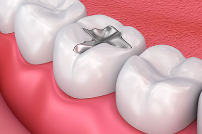 Great Marsh Dental | Dental Bridges, Invisalign reg  and Fluoride Treatment
