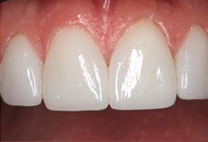 Great Marsh Dental | All-on-6 reg , Ceramic Crowns and Periodontal Treatment